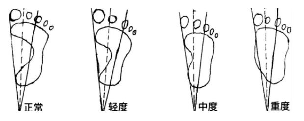 脚后跟骨刺怎么治疗