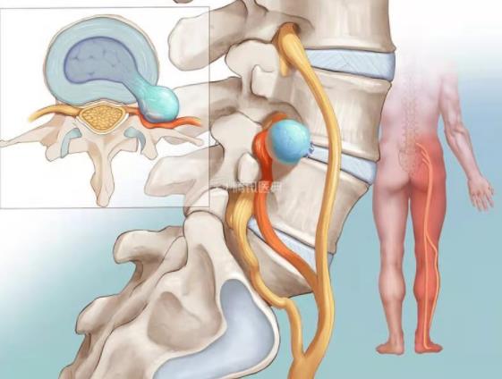 坐骨神经痛常见原因