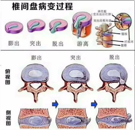 腰椎间盘膨出、突出、脱出，有哪些症状表现