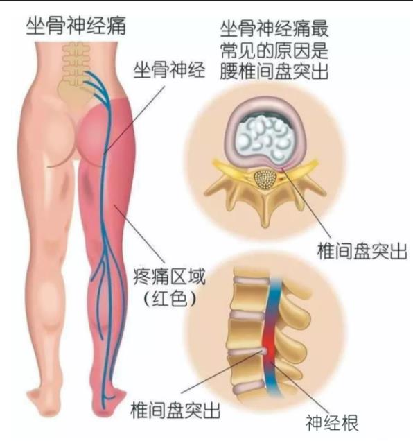 腰椎间盘突出可能出现的症状