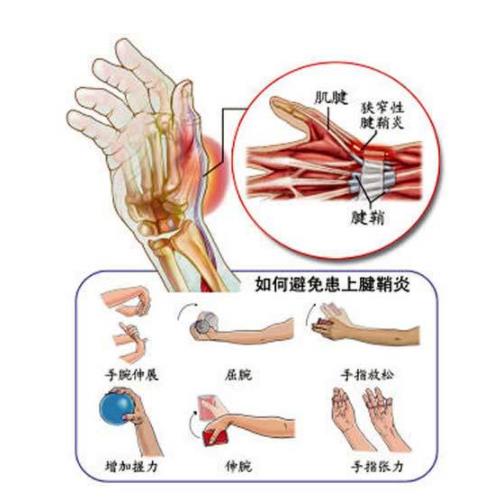 腱鞘炎患者应如何护理？