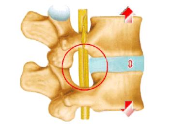 腰间盘突出产生的原因及详细介绍