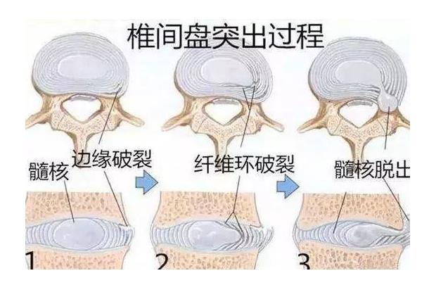 得了腰椎间盘突出还可以跑步吗？