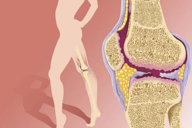 关节炎类型如何诊断